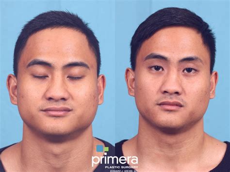 Buccal Fat Removal Before and After Photo Gallery | Orlando, Florida | Primera Plastic Surgery