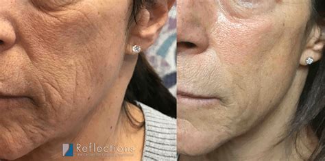 Difference Between Fraxel Dual Fraxel CO2 Lasers Total, 60% OFF