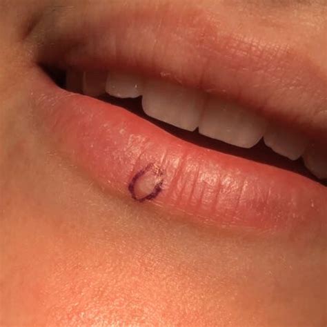 Mole on Lower Lip Removal | Excision Surgery & Healing