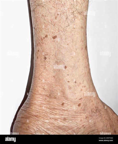 Age spots on the leg of Asian elder man. They are brown, gray, or black spots and also called ...