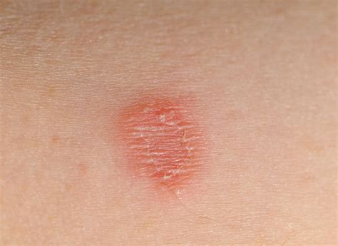 tinea corporis - DrBeckmann