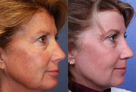 Fractionated Co2 Laser CO2 Laser Skin Resurfacing With Sculptra Facial
