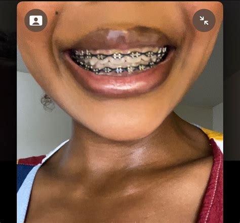 My Braces | Cute braces, Braces colors, Braces tips