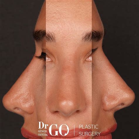Sculpting Symmetry: Precision Rhinoplasty Solutions | Nose surgery, Nose plastic surgery, Nose ...