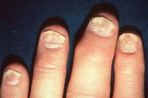 Can Nail Psoriasis Be Cured? 4 Best Nail Psoriasis Treatment Options - Be Your Best, Well, Self