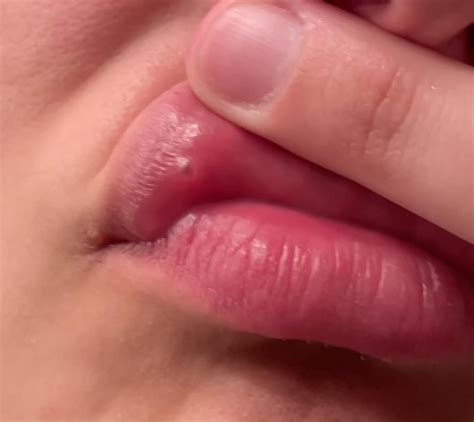Bumps on inner lip : r/PlasticSurgery