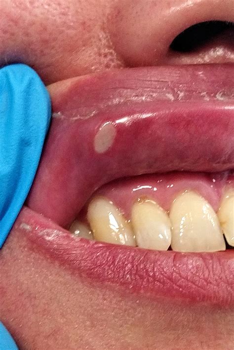 COVID‐19‐related acute genital ulcers - Falkenhain‐López - 2020 ...