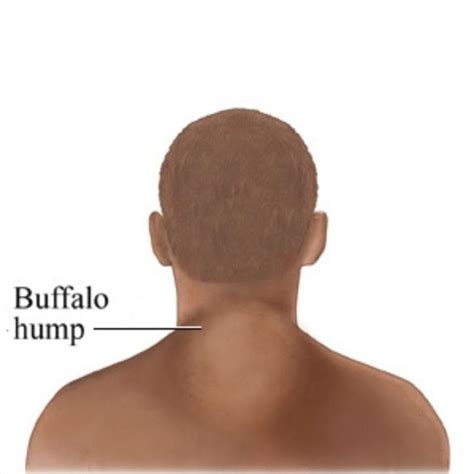 Buffalo Hump: Causes, Treatments, and Removal at Vivid Clinic