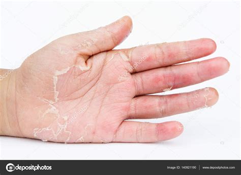 Newborn Baby Dry Skin Hands Feet at Samantha Hanlon blog