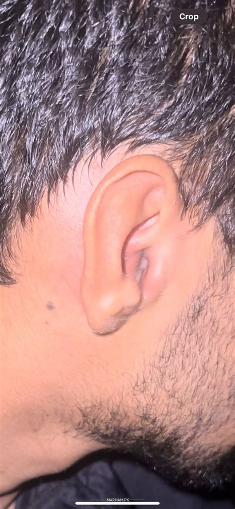Ask a Ent Specialist Online for Ear Sore And Extreme Pain