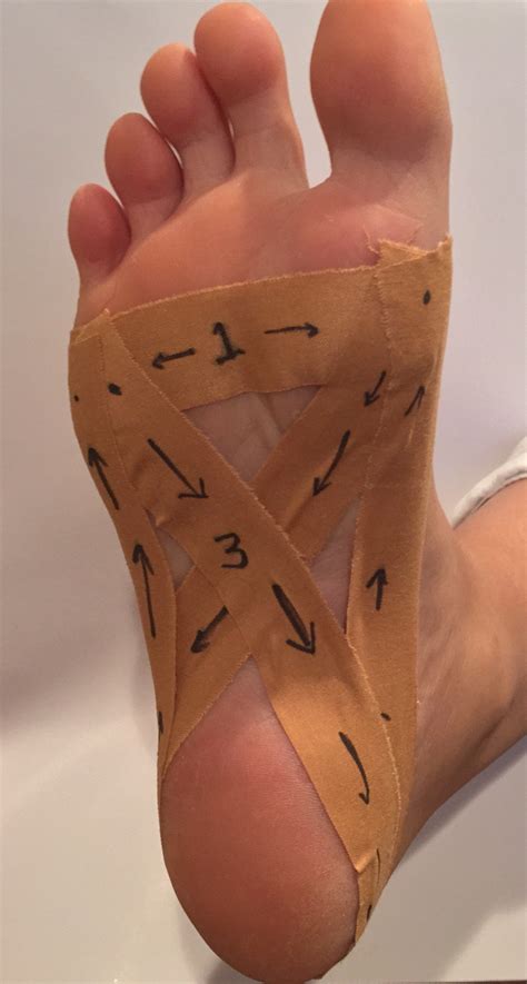 Plantar Fasciitis Foot Support at Elsie Tucker blog