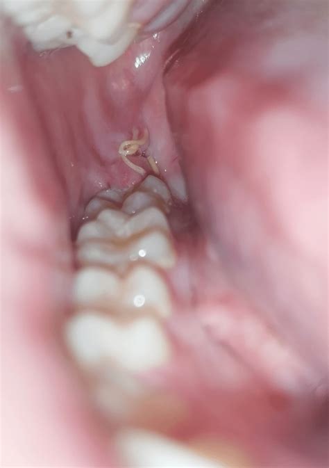 9 days post op (with dissolvable stitches) how's it looking?? : r/wisdomteeth