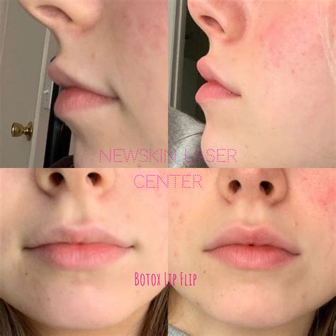 Lip Flip Before And After: Subtle Enhancement For A Fuller Smile