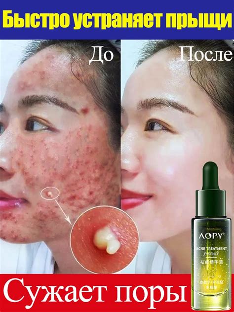 Сыворотка для лица от прыщей и сужения пор/ от акне, черных точек, от ...