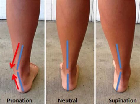 What is the Difference Between Foot Pronation vs Supination - Great ...