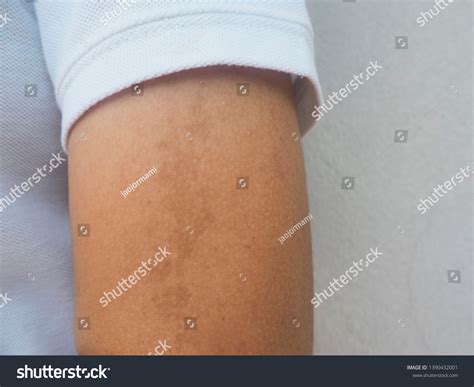 Dark Brow Birthmark Cafe Au Lait Stock Photo 1390432001 | Shutterstock