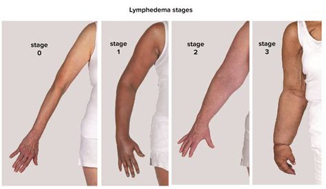 Lymphe-what? One woman’s story of a side effect of breast cancer | Blessing Health System