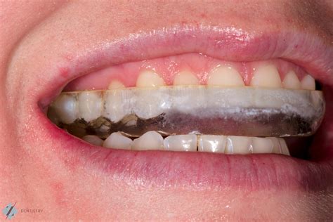 Night Guards: What Are They and Who Needs Them? | Z Dentistry