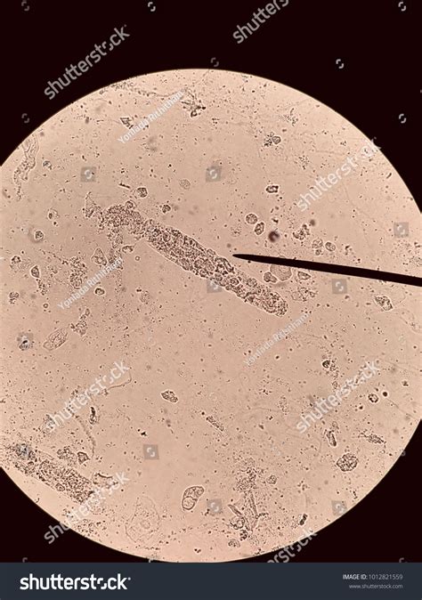 High Protein And Wbc In Urine at Ralph Livingston blog