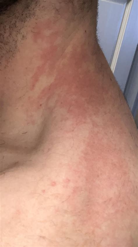 Often get rash around neck/shoulders, point me in the right direction? Can’t narrow down to any ...