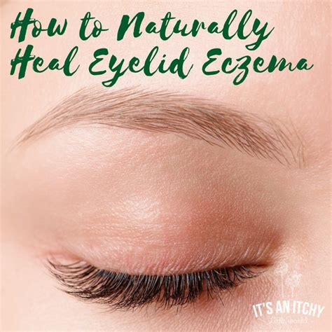 How to Naturally Heal Eyelid Eczema | It's an Itchy Little World