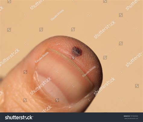 Tiny Blood Blister Finger