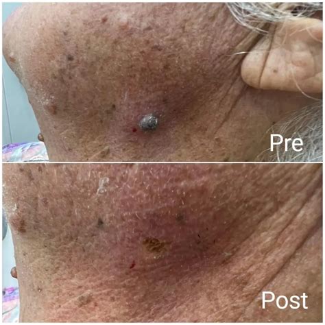 Seborrheic keratosis removal in Hurghada - Book now - Nadara Center