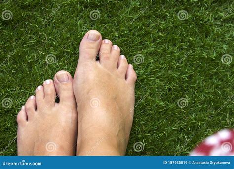 Top View of Female Legs with Fused Middle Toes on Green Grass Background. Webbed Toes Genetic ...