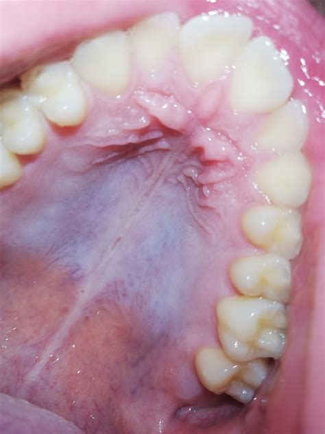 Roof Of Mouth White