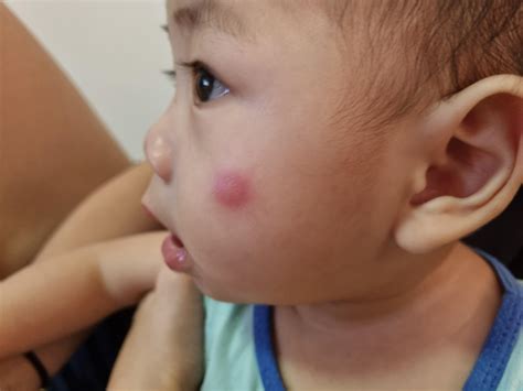 Flea Bites On Babies