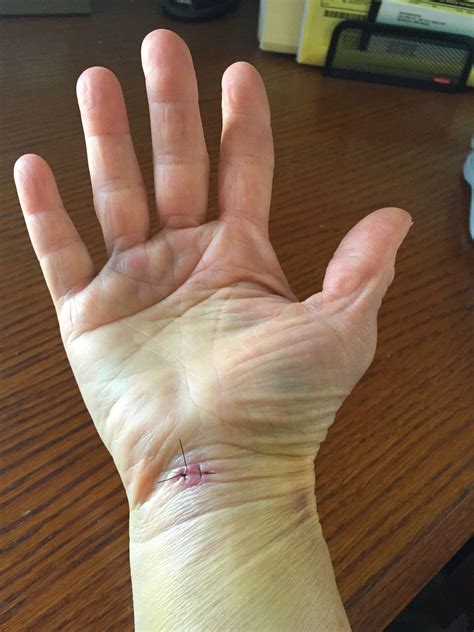 Carpal Tunnel Surgery: Carpal Tunnel Release Surgery – ZPFQL