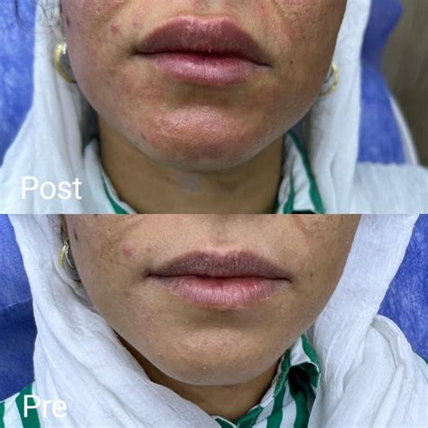 Lip augmentation in Hurghada - Book now - Nadara Center