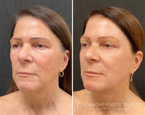 Deep Chemical Peels - Vermont Plastic Surgery