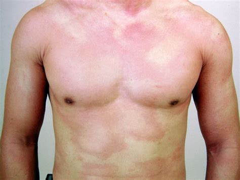 Hives vs. Rash: Symptoms, Causes, Treatment