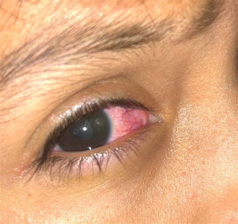 Ruptured Globe Eye