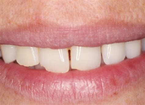 Gum Abscess Popped? Thinking of Popping It Yourself?