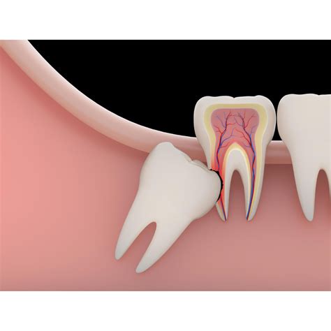 Back Molar Extraction: Procedure, Recovery, and Cost - Smile Studio Boston