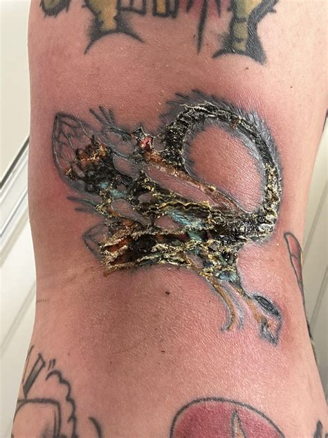 What do infected tattoos look like - Bronctattooaus.com
