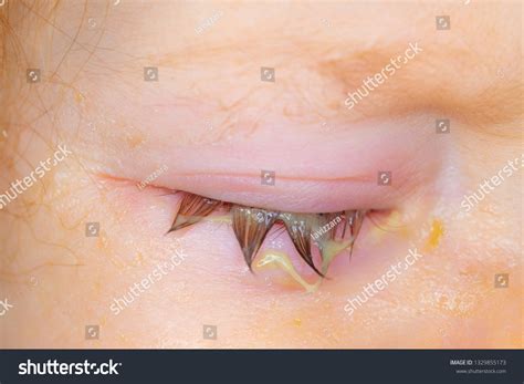 Swollen Sticky Eyelid Small Baby Conjunctivitis Stock Photo 1329855173 ...