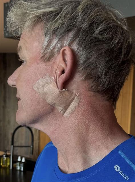 Gordon Ramsay shares skin cancer battle raises awareness for sun safety
