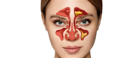 Nasal and Sinus Surgery for Chronic Sinusitis Relief