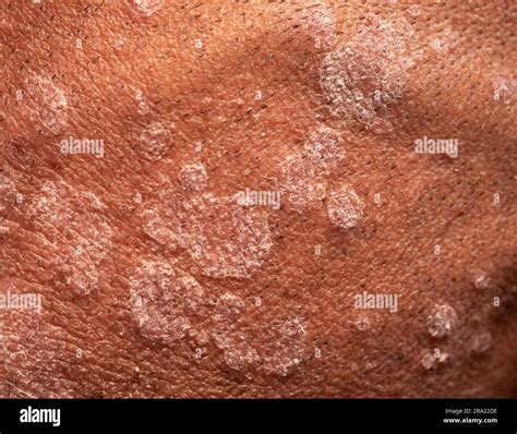 Close-up view of fungal infection of scalp hair. Tinea capitis, ringworm or herpes tonsurans ...