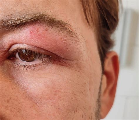 Eyelid and face eczema - Bragan Skincare