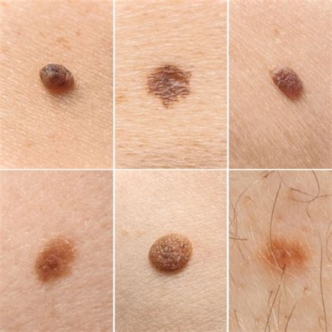 Intradermal Nevus: Understanding the Common Skin Growth