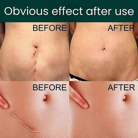 Silicone Scar Sheets for C-Section, Tummy Tuck, Keloid & Surgical Scars ...