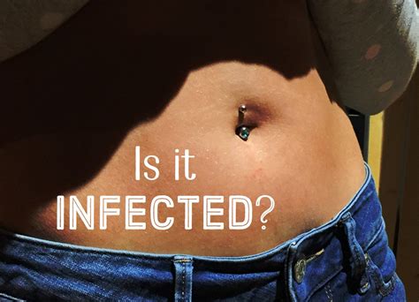 Belly Button Infection Antibiotics
