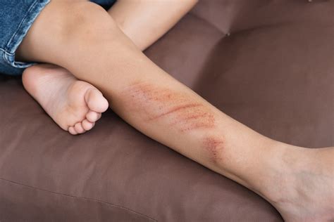 Abrasion Wound: What Are the Best Ways to Cuts and Scrapes?