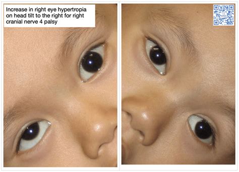 What Is Palsy Of The Eye at Megan Gerow blog