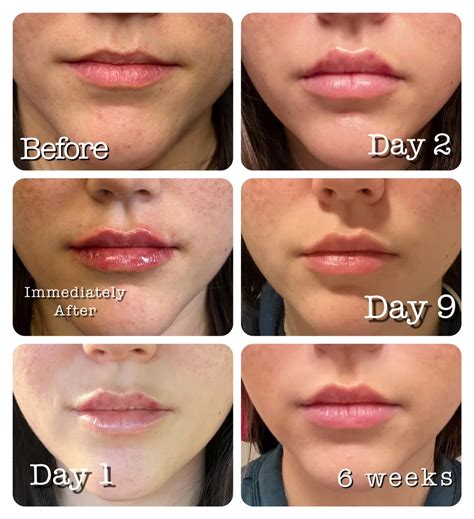Why Do My Lips Bruise So Much After Lip Filler | Lipstutorial.org