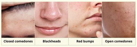 Paraania Pristine Skin for open & closed comedones